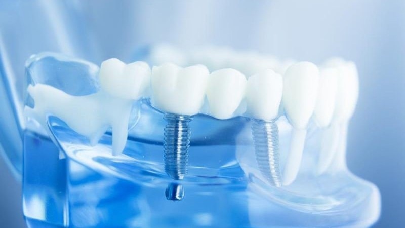 Vì sao nên lựa chọn phương pháp cấy răng implant khi mất răng?